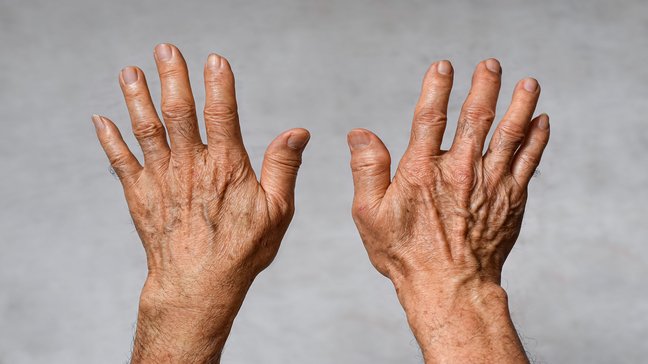 Orthopädiezentrum Wien – Kollagenschwäche bei einer Person, Handgelenke betroffen.